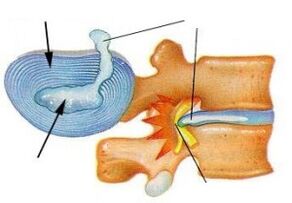 Zerstörung des Faserrings mit zervikaler Osteochondose