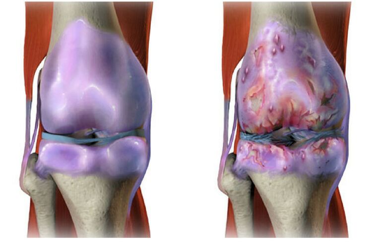 gesunder Knorpel und Zerstörung des Kniegelenks mit Arthrose