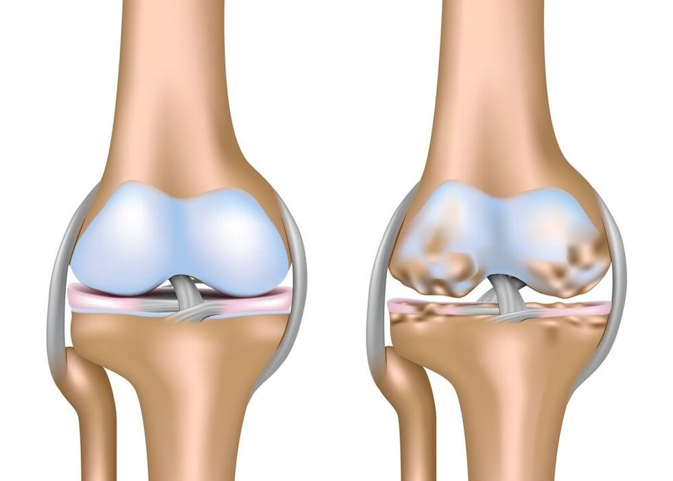Verschlimmerung der Arthrose der Gelenke